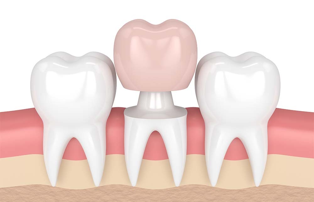 dental crown on natural tooth illustration