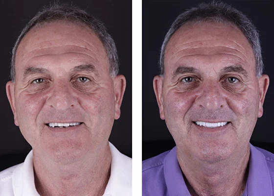 before and after bruxism treatment