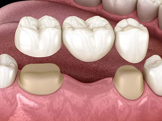 dental bridges on natural teeth