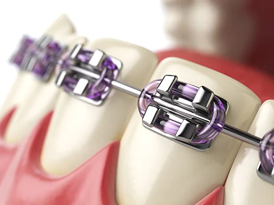 details of braces