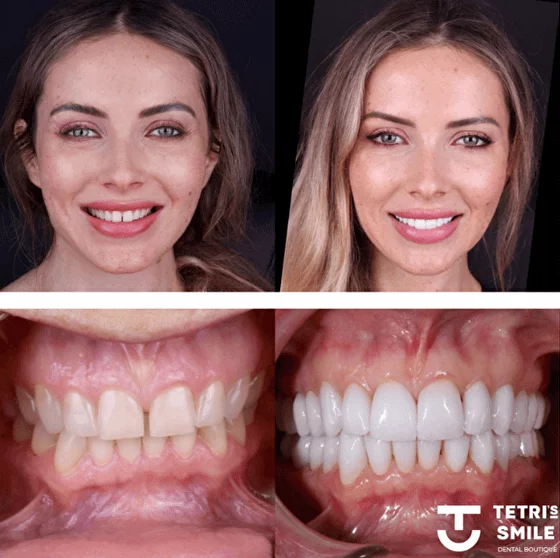 Before and after veneers