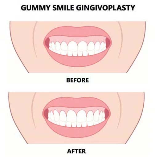 Gingivectomy foto
