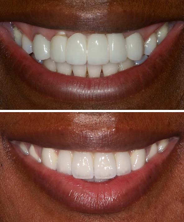 gingival inflammation before and after