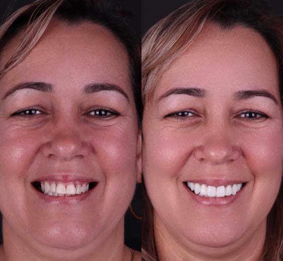 gummy smile before and after