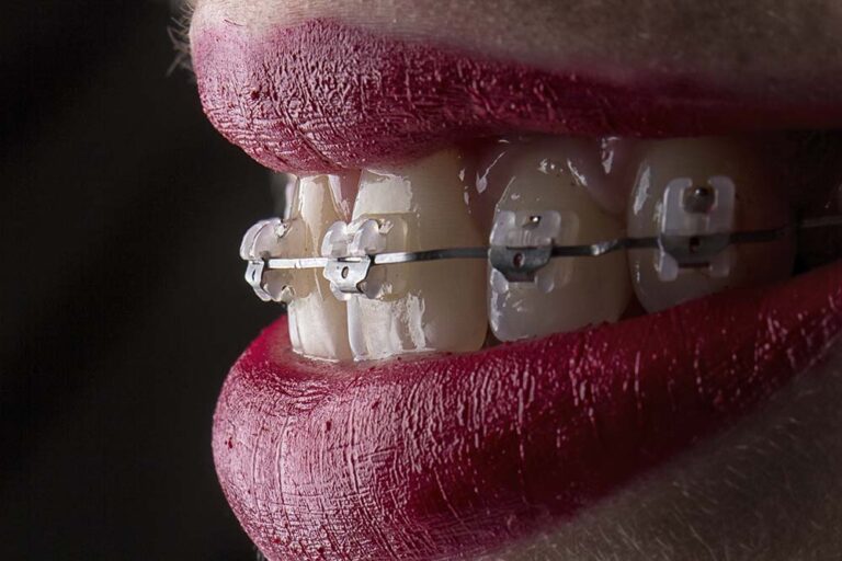 Ceramic braces near me