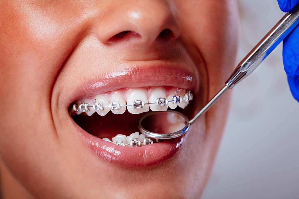 Fixed orthodontic structure