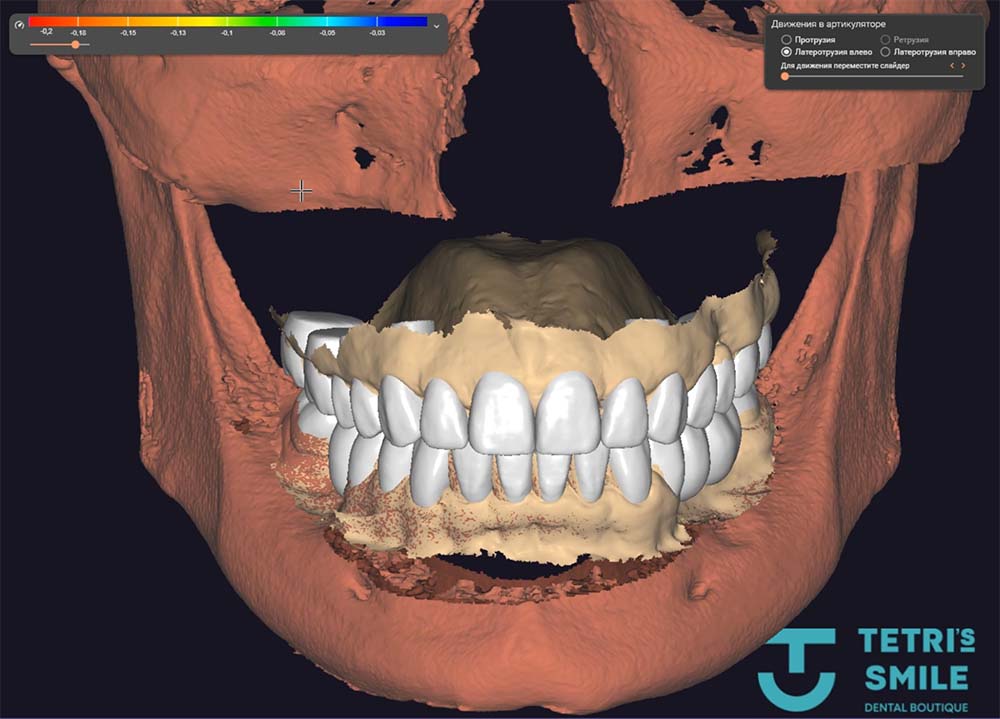 В компьютерной программе моделируется форма зубов, десен, губ и лица