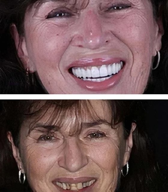 улыбка пациента до и после перелечивания каналов