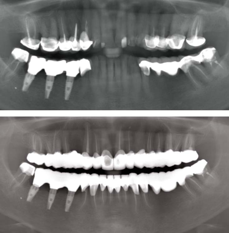 before / after root canal retreatment
