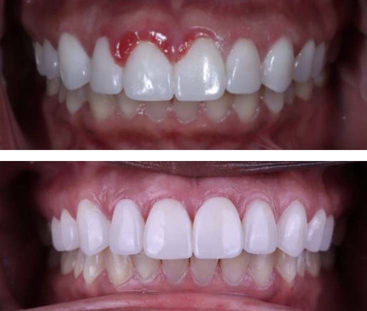 Gum treatments