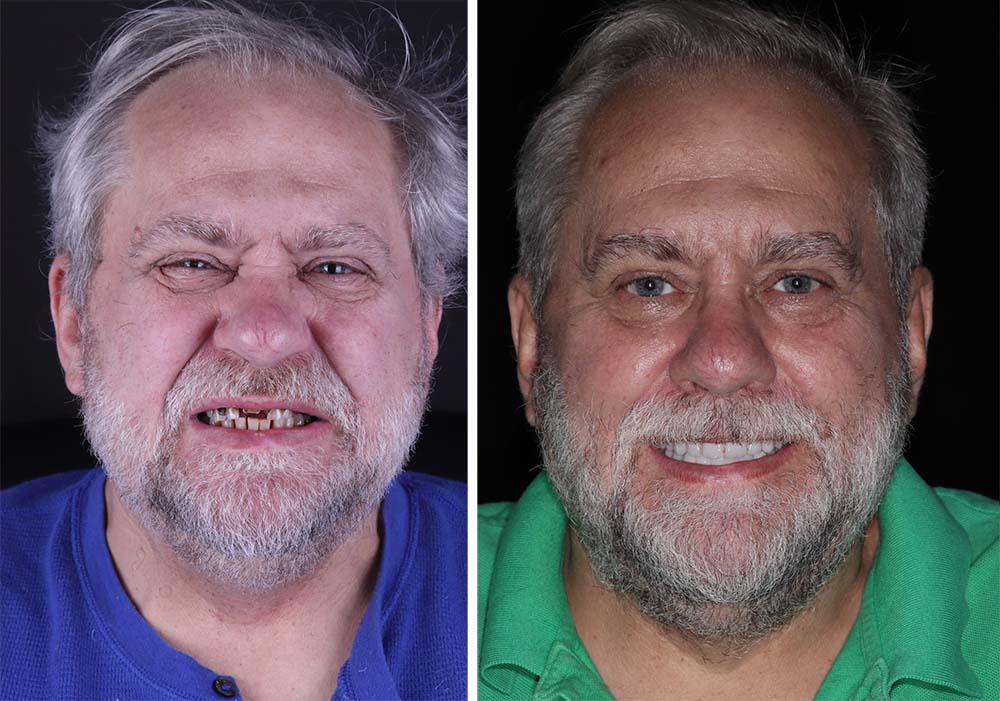 Лечение вторичного кариеса, фото до и после