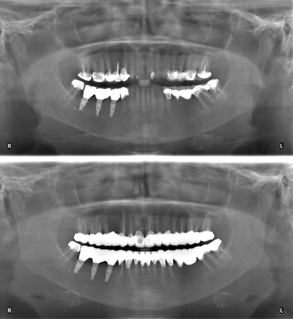 root canals before and after