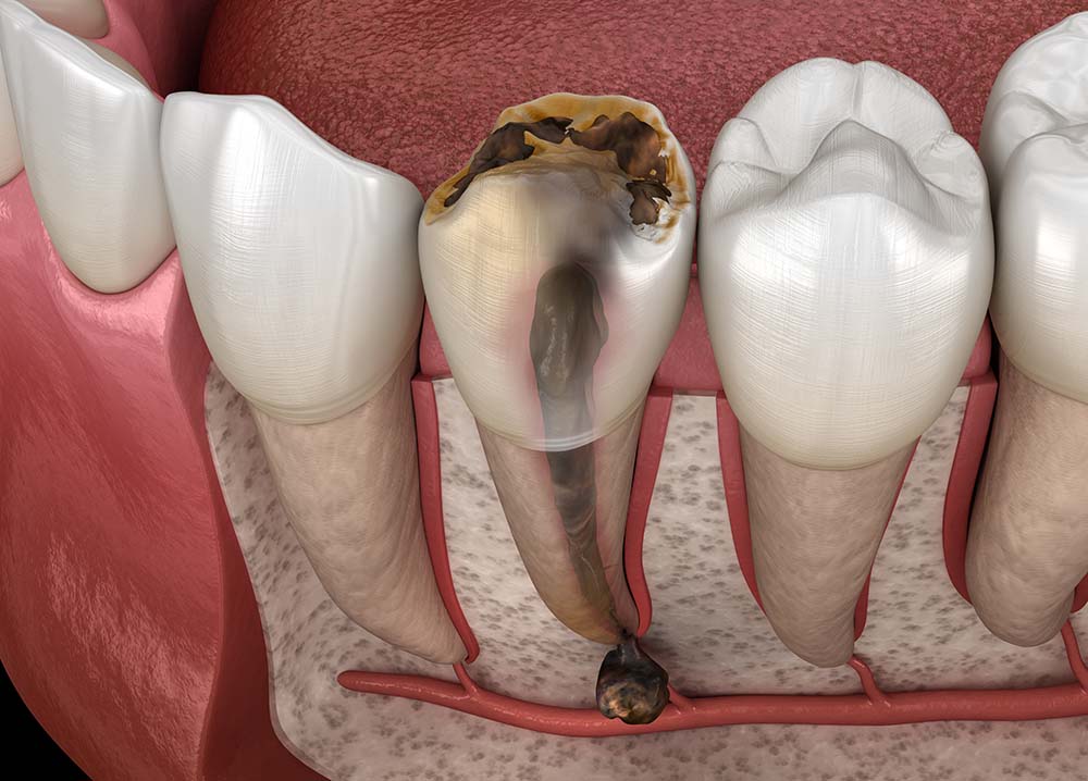 tooth cyst