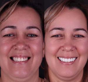 Gum correction case