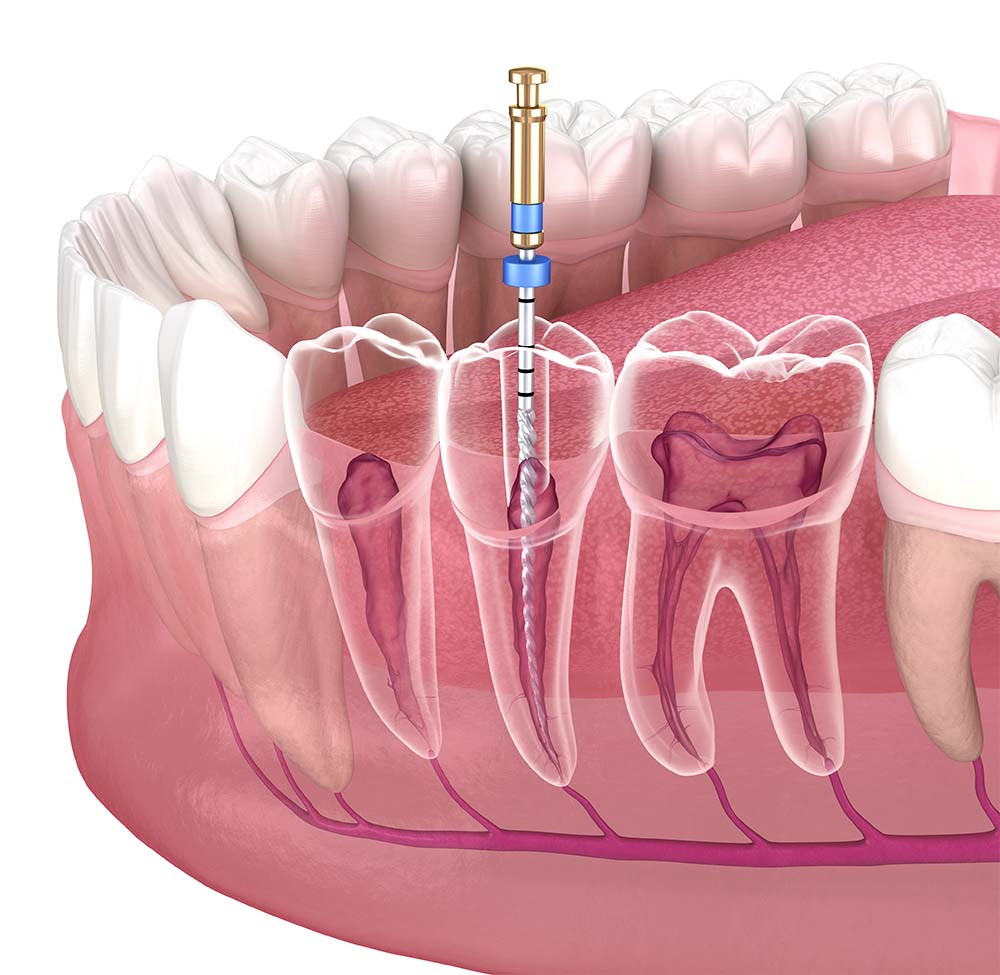 3D illustration of the process of endodontic treatment of root canals.