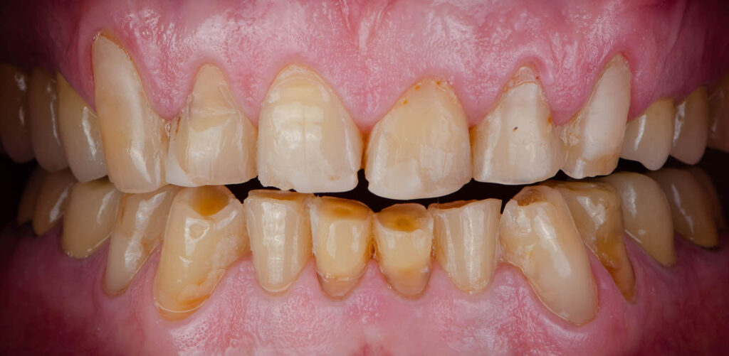Изношенные зубы