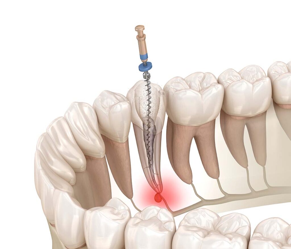 Endodontic root canal treatment process